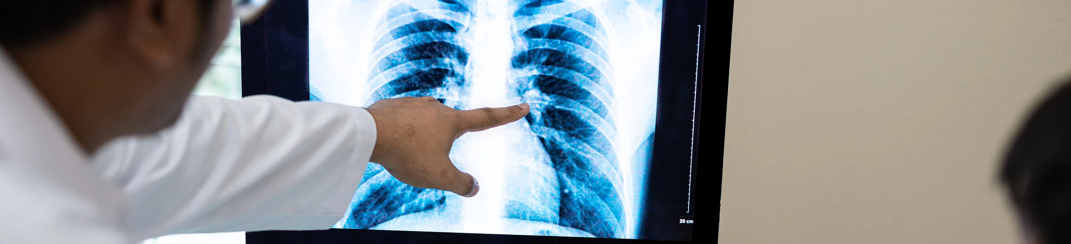 TB Then & Now: Koch’s Discovery Meets Modern Diagnostics